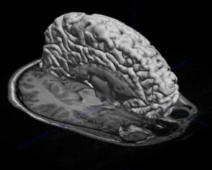 mri_overlay5
