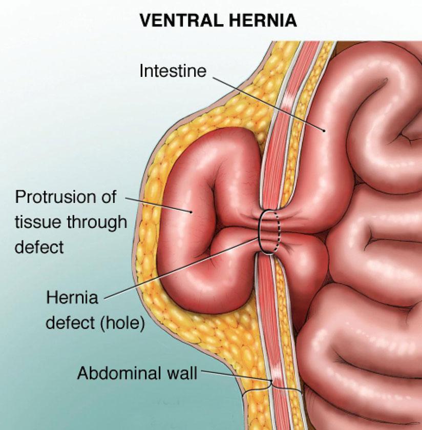hernias and types