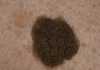 Seborrheic keratosis