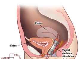 electric stimulation vagina