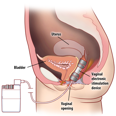 electric stimulation vagina