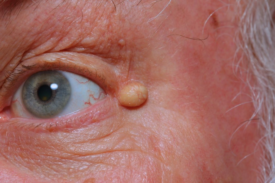 cysts