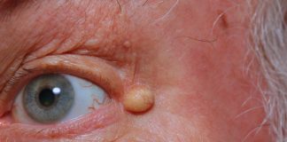 cysts