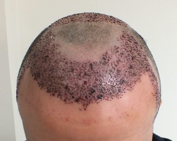 1-day-after-hair-transplant