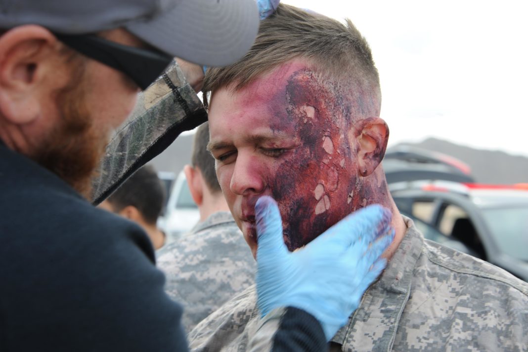burn victim military