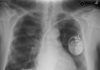 What is Mesothelioma?