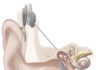Cochlear Implants