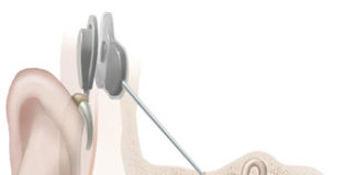 Cochlear Implants