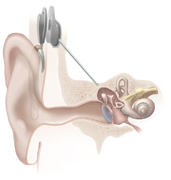 Cochlear Implants