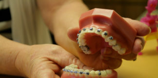 tooth decay