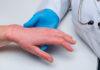 Chronic Hand Eczema Management: Innovative Approaches to Diagnosing and Treating Persistent Hand Eczema