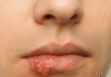 Understanding Herpes Simplex: What You Need to Know